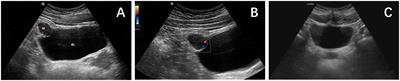 Case report: Urachal perivascular epithelioid cell tumor